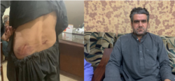 عبدالمتین اڅکزی د خیبر ټي وي خبریال خپل ټپونه ښيي. ۲۰۲۰، ۲۲ جون
